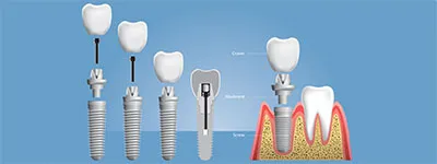Restorative dentistry