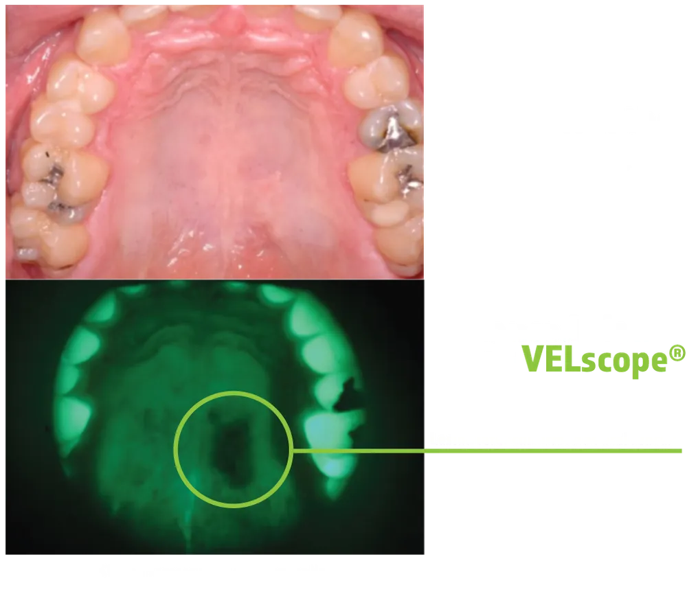 VELscope fluorescence imaging showing a lesion not visible under normal light