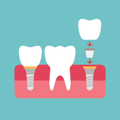 What Does a Dental Implant Procedure Look Like? | Dorothy Paul, DDS
