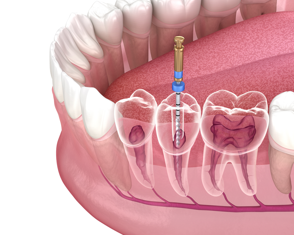 Root Canal | Houston Dentistry