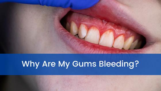Why Are My Gums Bleeding?